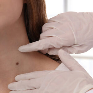 Laser Mole Removal Treatment