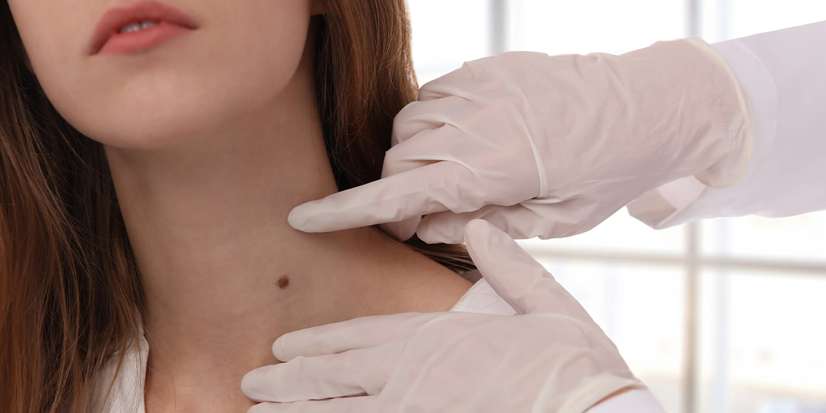 Laser Mole Removal Treatment