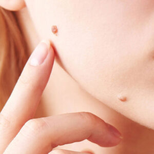 Laser Wart Treatment