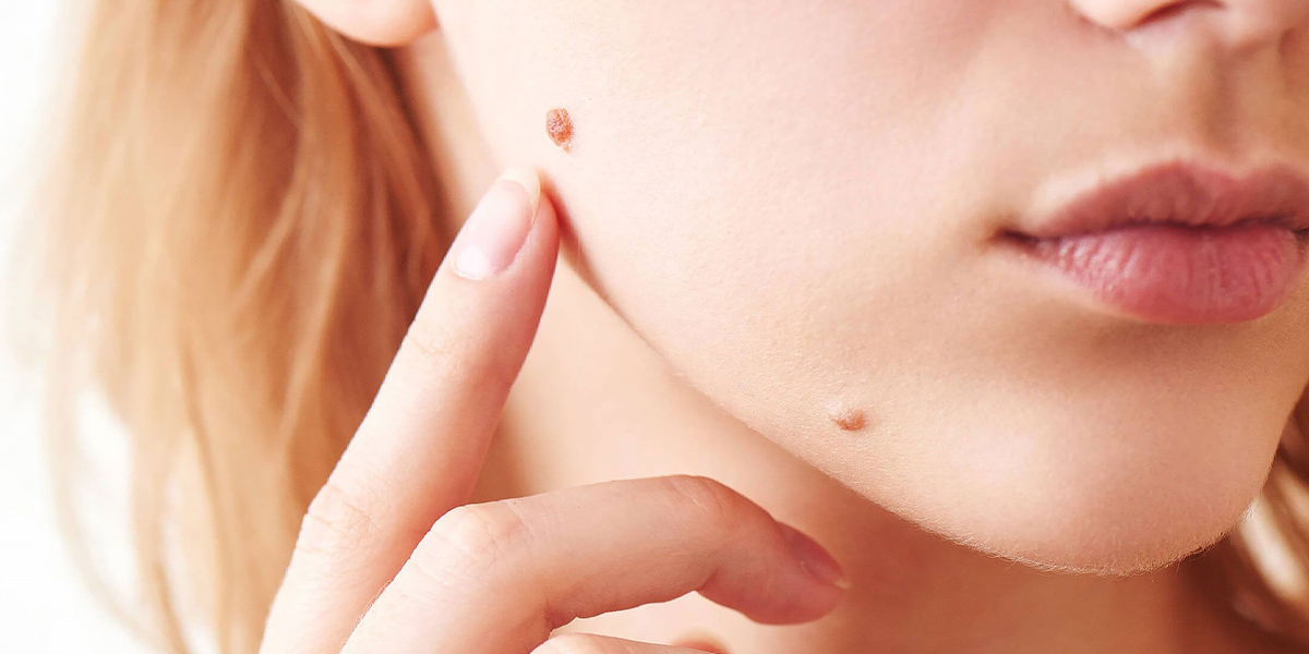 Laser Wart Treatment