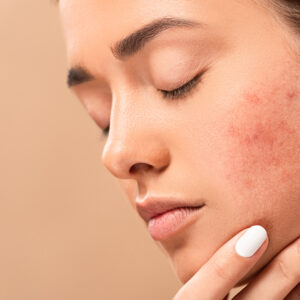 ND Yag Laser Capillary Treatment