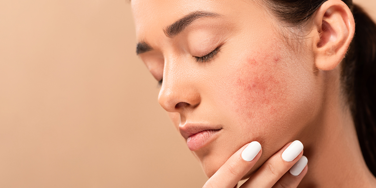 ND Yag Laser Capillary Treatment