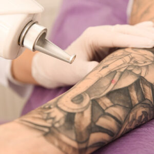 Q Switch Laser Tattoo Removal