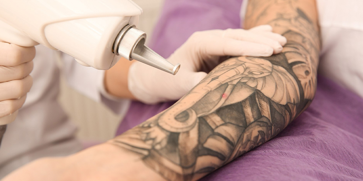 Q Switch Laser Tattoo Removal